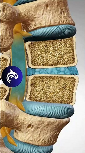 Vertebral Osteoporosis (Spinal Osteoporosis) - 4K 3D Animation