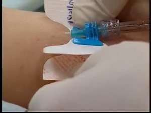 StatLock Ultra IV Stabilization Device