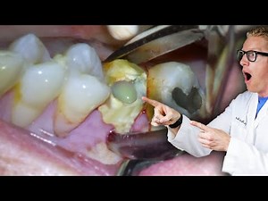 Badly Infected Tooth Extraction Procedure With Pus Coming Out of The Tooth • Video • MEDtube.net