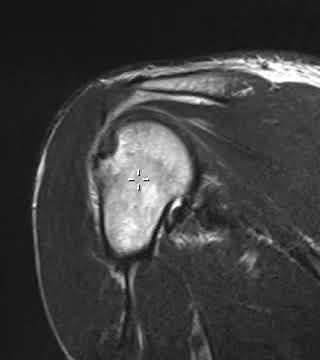 Rotator cuff tear