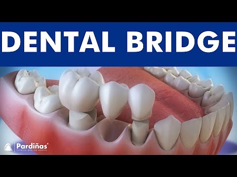 Dental bridge - Fixed dental replacement ©