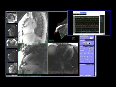 Right Heart Catheterization