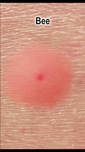 What Different Insect Bites Look Like