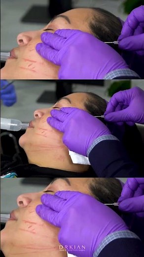 The Truth About PDO Threads -Explained by Plastic Surgeon Dr. Kian