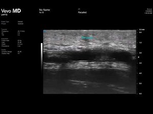 TEMPORAL ARTERY HIGH RESOLUTION ULTRASOUND
