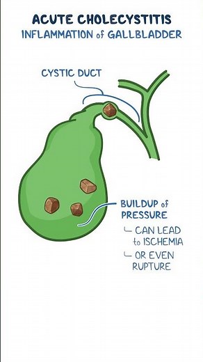 Acute cholecystitis