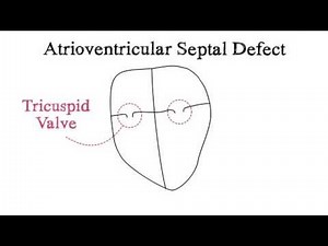 Atrioventricular Septal Defect (AVSD)