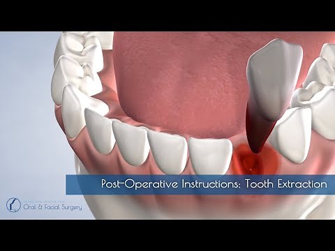 Post-Operative Instructions: Tooth Extraction