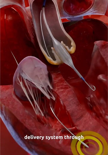 Understanding TAVI Procedure for Aortic Valve Stenosis