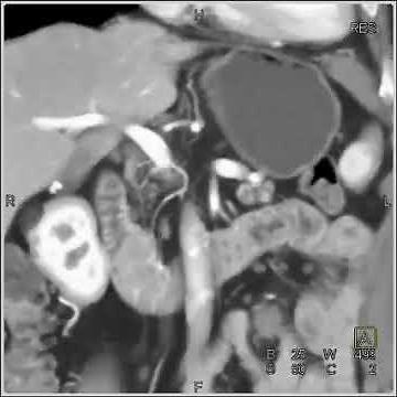 Adenocarcinoma Duodenum 3