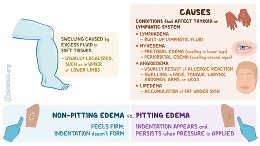 Non-pitting Edema: What Is It, Causes, Diagnosis, Treatment, and More | Osmosis
