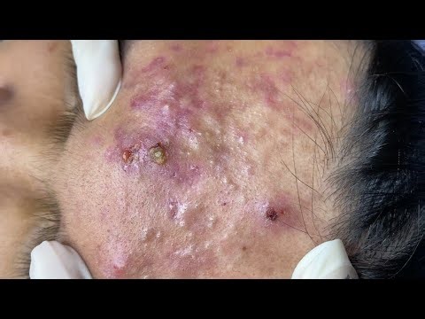 Deep Pimple Removal | Full Face Acne Cleaning with Relaxing Music | Pimple Removal