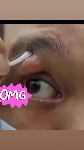 How to Properly Pop a Pimple in Your Armpit