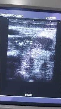 Ultrasound Neck... abscess in the deep spaces of neck