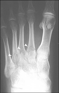 Metatarsal Fracture Fixation (Open Reduction and Internal Fixation)