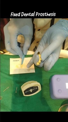 5 Unit Dental Bridge Fixing – Front Teeth Replacement | Fixed Dental Prosthesis | डेंटल ब्रिज