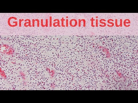 What is Granulation Tissue? - Pathology mini tutorial