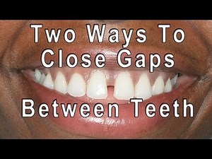 How to Get Rid of Gaps in Teeth