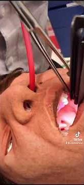 Tips for Nasal Intubation