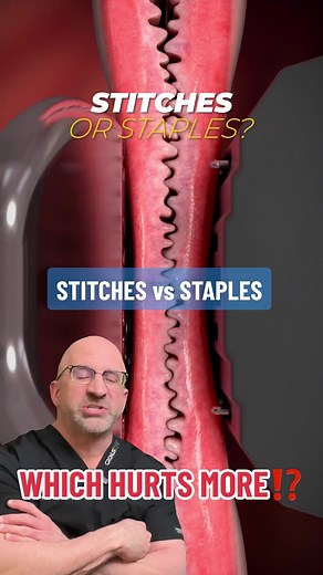 Did you have stitches or staples? 👇 SHARE your wound healing experience . Benefits of Skin Staples Staples may be simpler, stronger, and speedier to use to close large, open wounds than traditional stitches, and may be used after major surgery. For example, staples may used in trauma surgery for a faster closure and to shorten time under anesthesia or even after C-sections to help the (larger) incision heal faster while also reducing scar appearance. Bleeding or reopening of an incision can hap