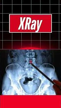 How is Disc Surgery Performed? | Dr. Puneet Malik | Neurologist Explains Step-by-Step