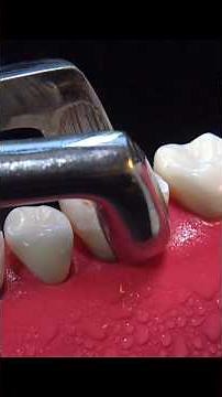 INCREDIBLE dental implant procedure - Explained step by step