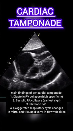 Echo Features of Pericardial Tamponade #echocardiography #heartdisease #heart #health