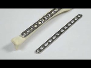 Axial Compression Plating of a Transverse Fracture with a Dynamic Locking Plate (Technique Overview)