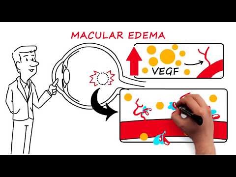 Retinal Vein Occlusion