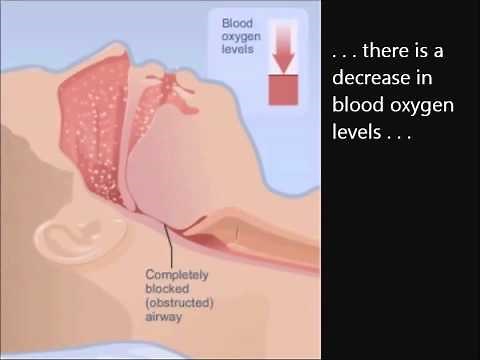 How CPAP works 5_23_11.wmv
