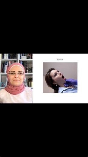 ‎الدكتور خلدون البريهي أخصائي جراحة الفم والوجه والفكين‎ on Instagram‎: "🔹 خلع المفصل الفكي الصدغي (Open Lock TMJ / TMJ Dislocation) 🔹 الأسباب | Causes ➡️ فرط فتح الفم (التثاؤب الشديد، الضحك، الصراخ) ➡️ إجراءات الأسنان الطويلة مع فتح فم واسع ➡️ ضعف أو ارتخاء أربطة المفصل الفكي الصدغي ➡️ صدمة مباشرة على الفك السفلي ➡️ تشنج عضلات المضغ بعد الفتح المفرط ➡️ تكرار الخلع السابق (Habitual dislocation) ➡️ Excessive mouth opening (yawning, laughing, shouting) ➡️ Prolonged dental procedures with wide mo