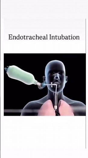 Endotracheal Intubation Explained | Step-by-Step Process, Indications, Complications | Airway #nurse