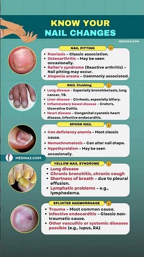 5 Nail Changes That Signal BIG Health Problems