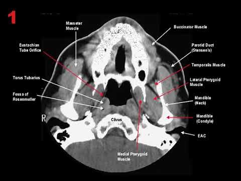 CT Scan of neck axial