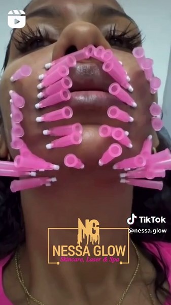 PDO Mono Threads for Effective Skin Tightening