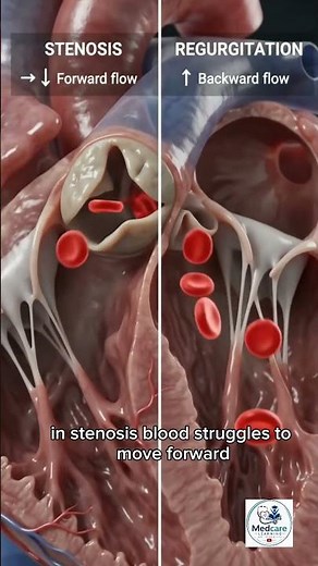 Valvular Heart Disease: Stenosis and Regurgitation Explained (3D Animation)