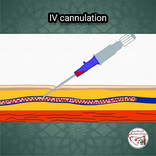 💉 INTRAVENOUS (IV) CANNULATION ANIMATION