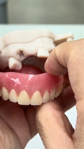 Lower partial and upper immediate denture from all teeth extracted!