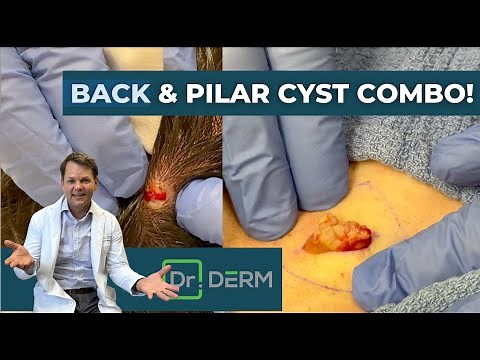 Back & Pilar Cyst Combo! | Dr. Derm