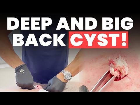 DEEP AND BIG BACK CYST!