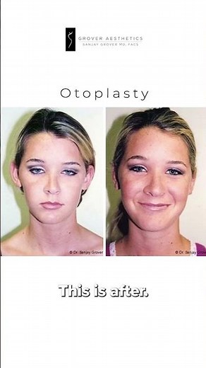 What Is Otoplasty? Dr. Grover on Ear Surgery & Before/After Results