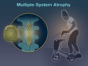 Patients with multiple-system atrophy often have debilitating orthostatic hypotension. An implanted spinal cord stimulator could help to manage this hypotension and related syncope. New research findings are summarized in a short video. https://nej.md/37f5ovs | The New England Journal of Medicine