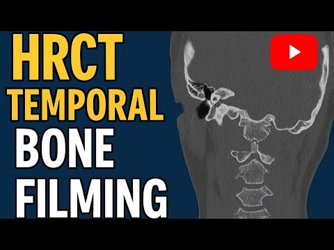 HRCT Temporal Bone | High-Resolution CT Scan for Ear and Skull Base Filming