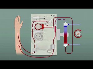 DIF (Infusión con líquido de diálisis) en Surdial X