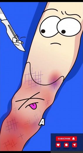 How Amputation Surgery Works: Step by Step