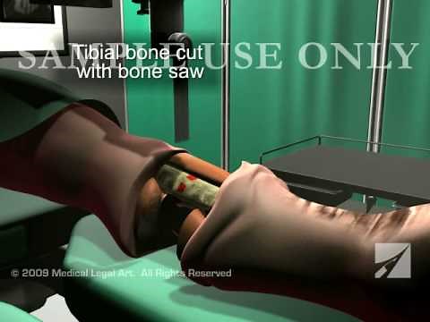 Lower Leg Amputation Surgery (Amputated Leg)