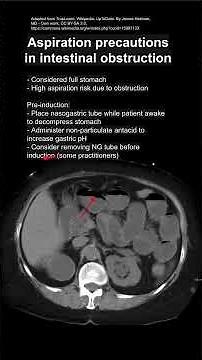 Aspiration precautions in intestinal obstruction