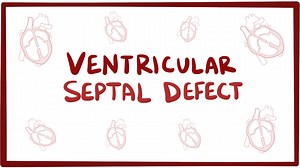 Ventricular septal defect: Video, Causes, & Meaning | Osmosis