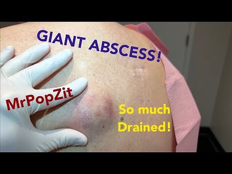 Very full abscess on back is drained with Incision & Drainage procedure. Follow up at end of video.