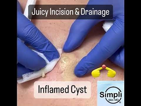 Inflamed Cyst Incision & Drainage